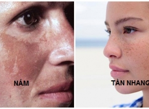 “Cần biết” nám da và tàn nhang khác nhau như thế nào?